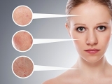 Trị nám uy tín tại Bình Dương - Ly Spa mang đến làn da sáng mịn và rạng rỡ