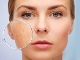 Điều Trị Sẹo Rỗ 100%