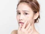 Điều Trị Mụn Đặc Biệt