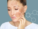 Điều Trị Nám Đặt Biệt