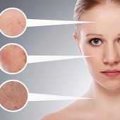 Trị nám uy tín tại Bình Dương - Ly Spa mang đến làn da sáng mịn và rạng rỡ